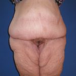 Panniculectomy Before & After Patient #3582