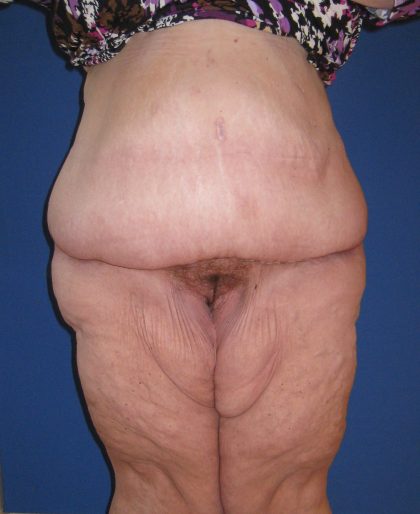 Panniculectomy Before & After Patient #3582