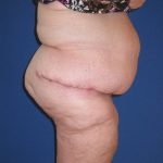 Panniculectomy Before & After Patient #3582