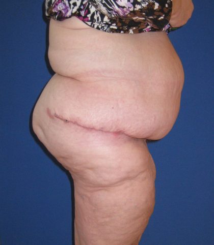 Panniculectomy Before & After Patient #3582