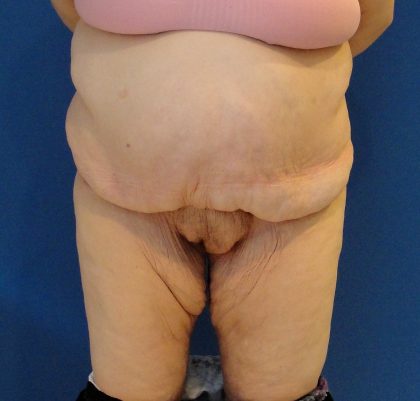 Panniculectomy Before & After Patient #3587