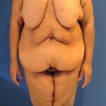 Panniculectomy Before & After Patient #3592