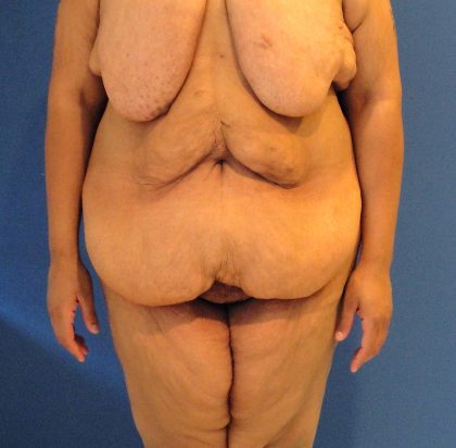 Panniculectomy Before & After Patient #3592