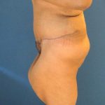 Panniculectomy Before & After Patient #3592