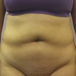 Liposuction Before & After Patient #3648