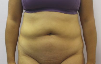 Liposuction Before & After Patient #3648