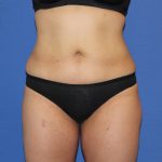 Liposuction Before & After Patient #3648