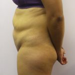 Liposuction Before & After Patient #3648