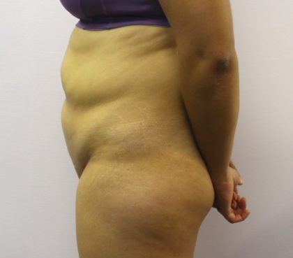 Liposuction Before & After Patient #3648