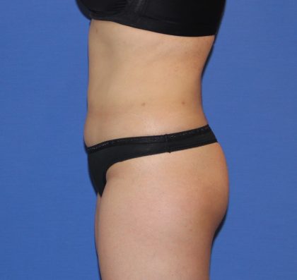 Liposuction Before & After Patient #3648