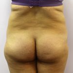 Liposuction Before & After Patient #3648