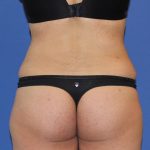 Liposuction Before & After Patient #3648