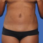 Liposuction Before & After Patient #3655