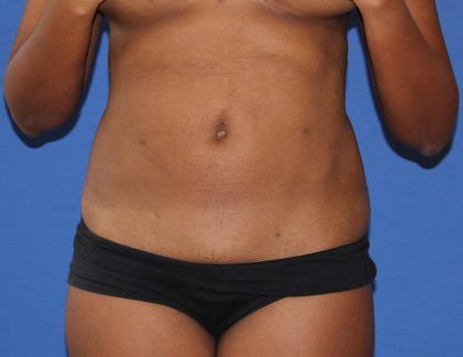 Liposuction Before & After Patient #3655