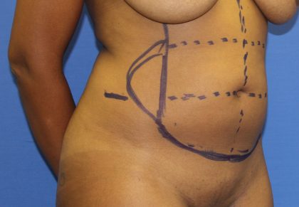 Liposuction Before & After Patient #3655