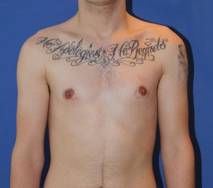 Liposuction Before & After Patient #3671