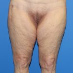 Thigh Lift Before & After Patient #3597
