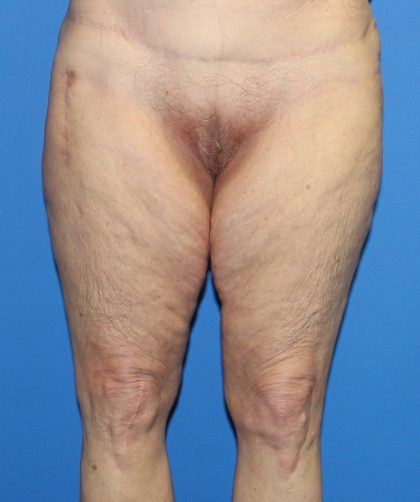 Thigh Lift Before & After Patient #3597