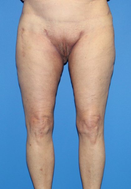 Thigh Lift Before & After Patient #3597