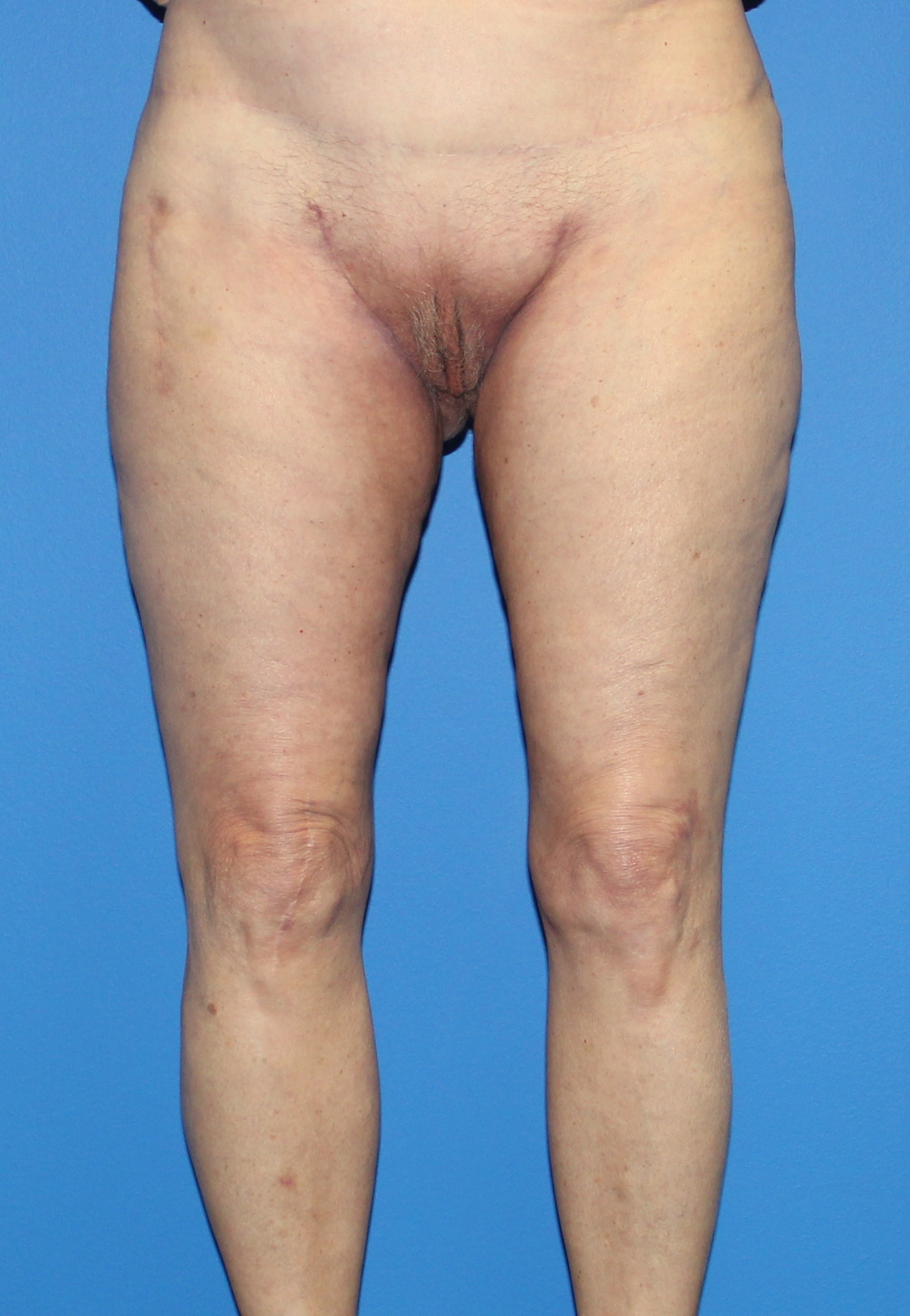 Thigh Lift Before & After Patient #3597