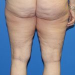 Thigh Lift Before & After Patient #3597