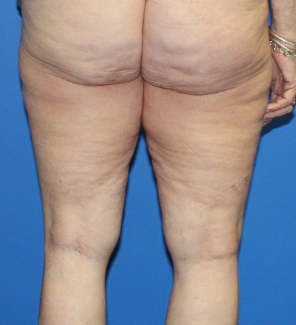 Thigh Lift Before & After Patient #3597