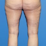 Thigh Lift Before & After Patient #3597