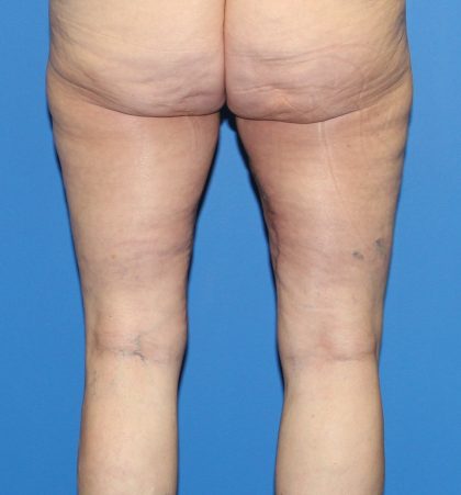 Thigh Lift Before & After Patient #3597