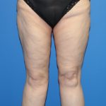 Thigh Lift Before & After Patient #3635