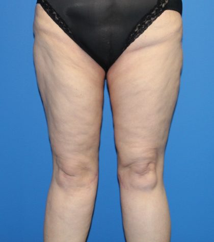 Thigh Lift Before & After Patient #3635