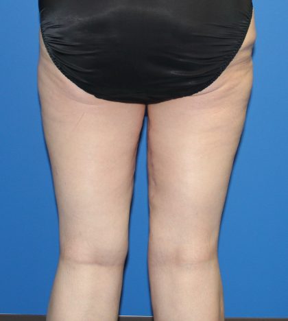 Thigh Lift Before & After Patient #3635