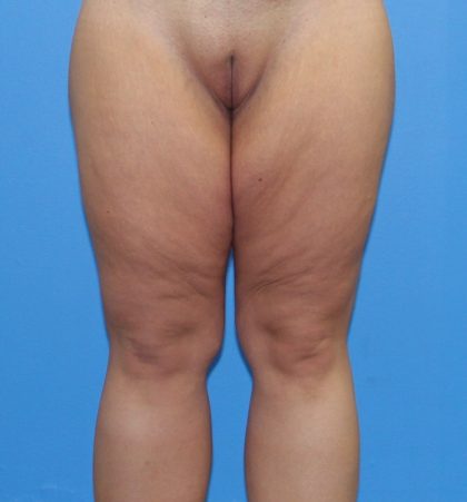 Thigh Lift Before & After Patient #3602