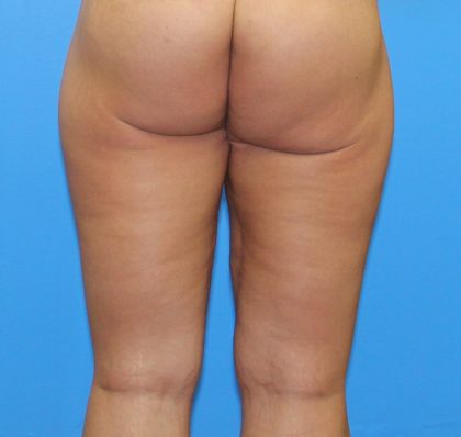 Thigh Lift Before & After Patient #3602