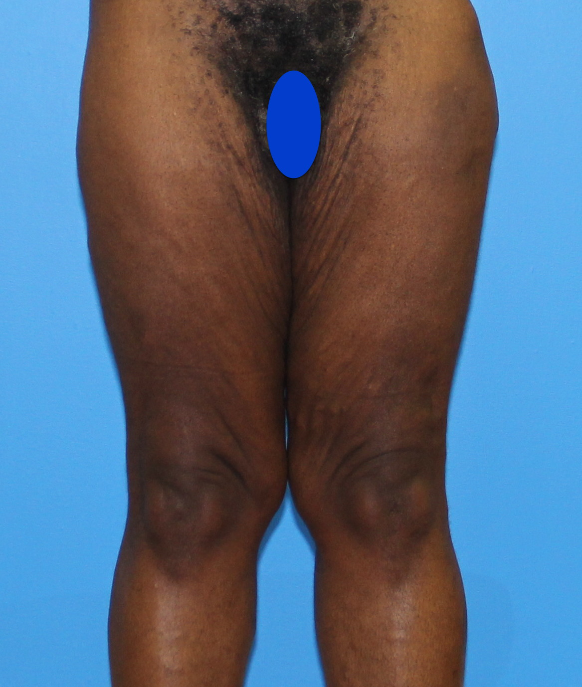 Thigh Lift Before & After Patient #3608