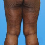 Thigh Lift Before & After Patient #3608