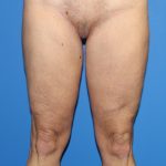 Thigh Lift Before & After Patient #3613