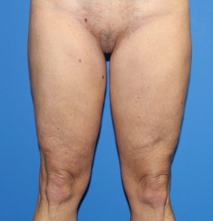 Thigh Lift Before & After Patient #3613