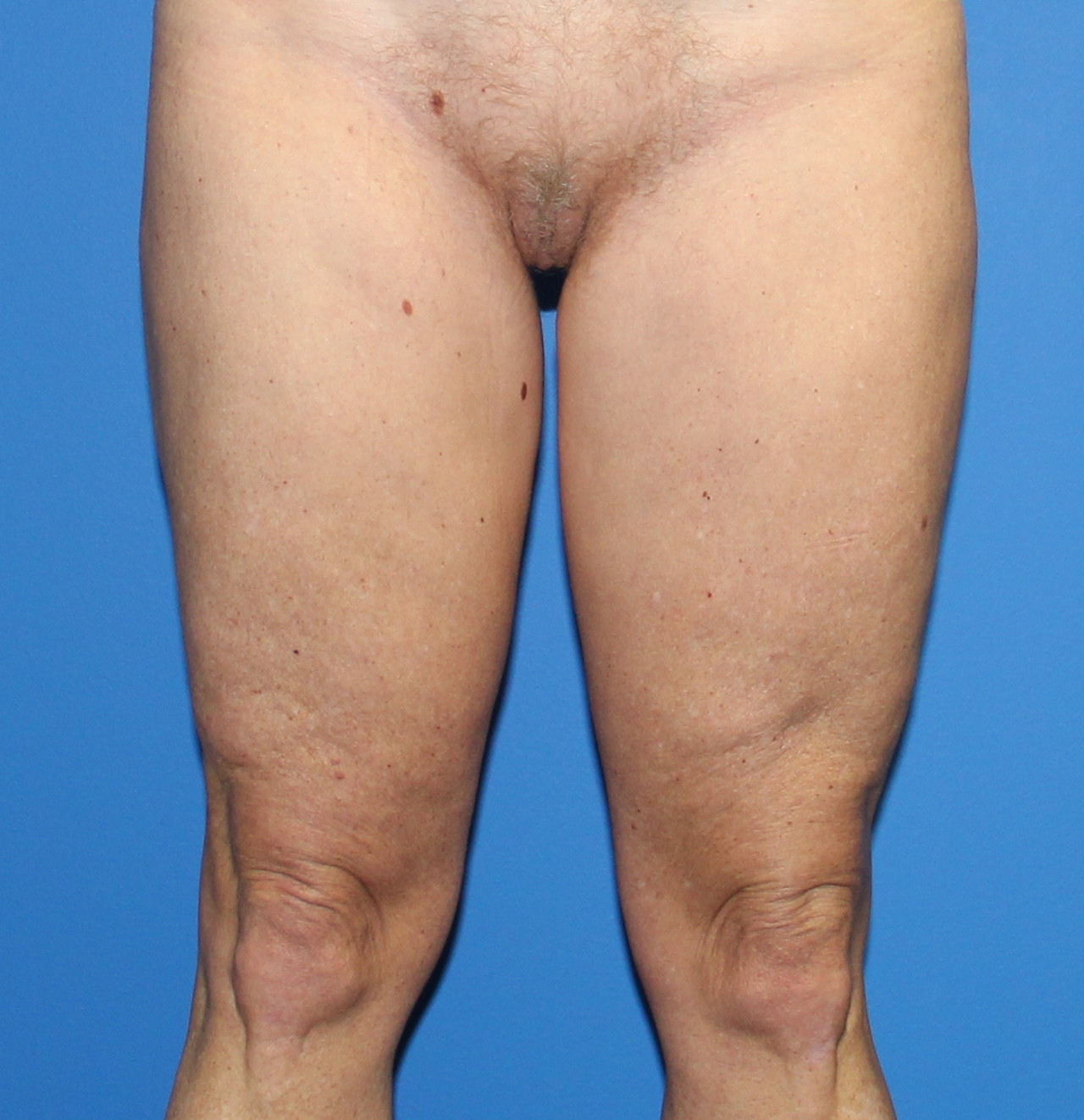 Thigh Lift Before & After Patient #3613