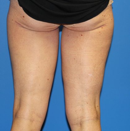 Thigh Lift Before & After Patient #3613