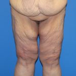 Thigh Lift Before & After Patient #3618