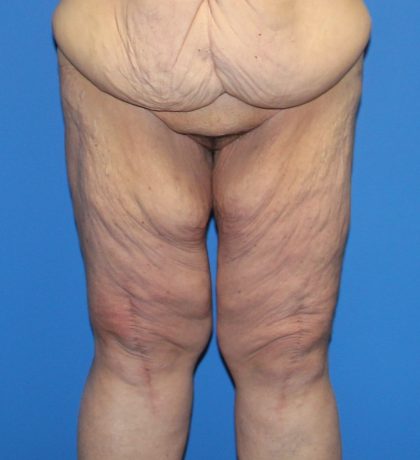 Thigh Lift Before & After Patient #3618