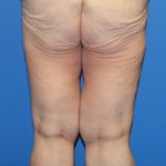 Thigh Lift Before & After Patient #3618