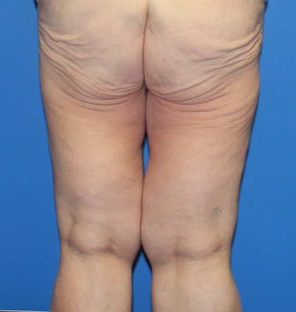 Thigh Lift Before & After Patient #3618