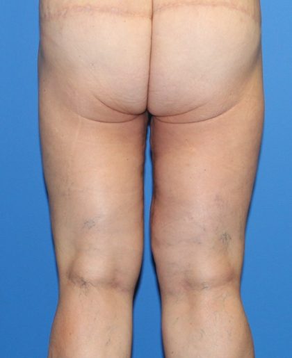 Thigh Lift Before & After Patient #3618