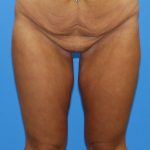 Thigh Lift Before & After Patient #3623