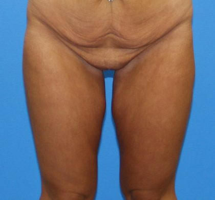 Thigh Lift Before & After Patient #3623