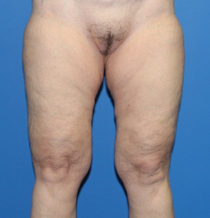 Thigh Lift Before & After Patient #3626