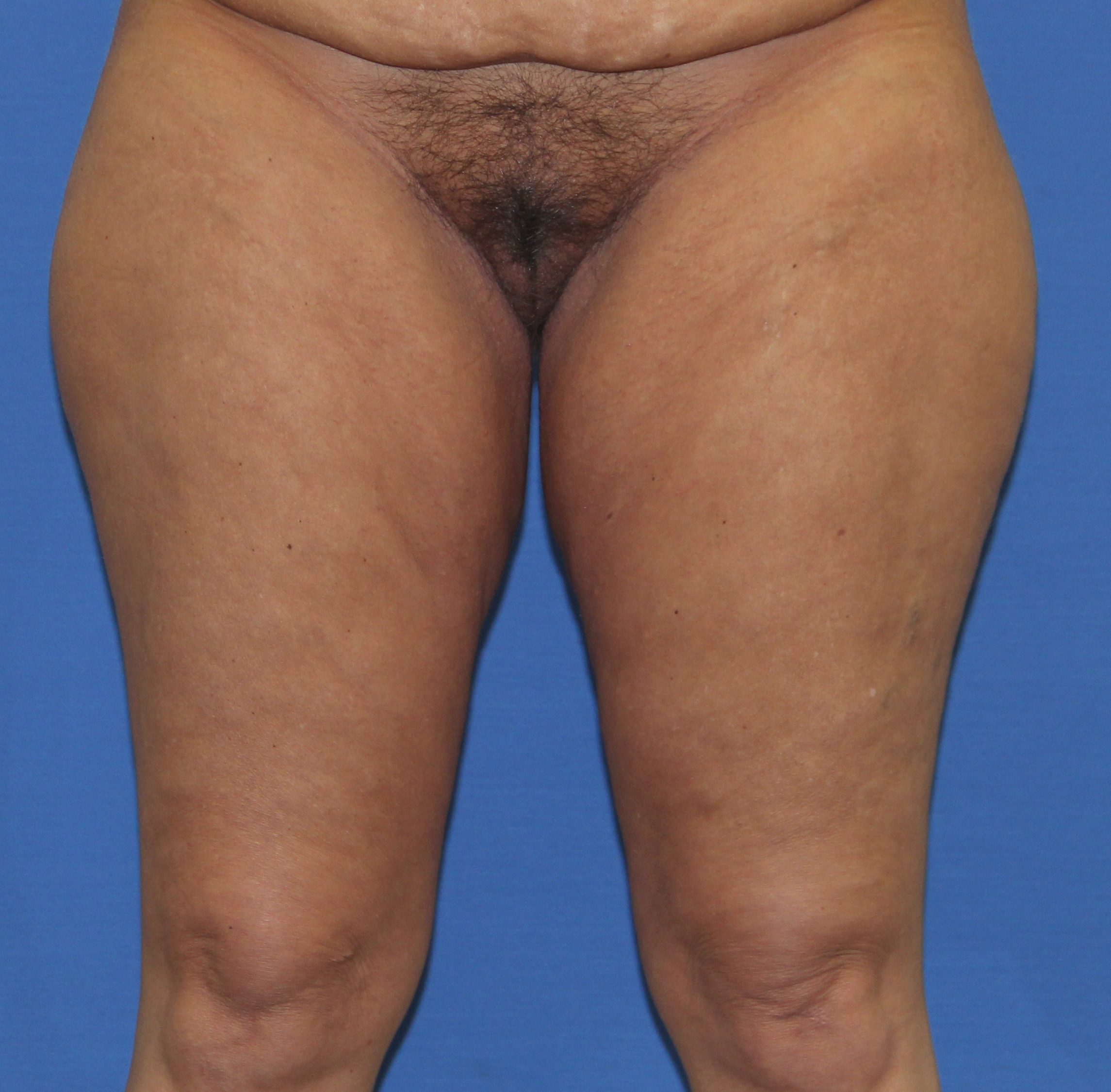 Thigh Lift Before & After Patient #3632
