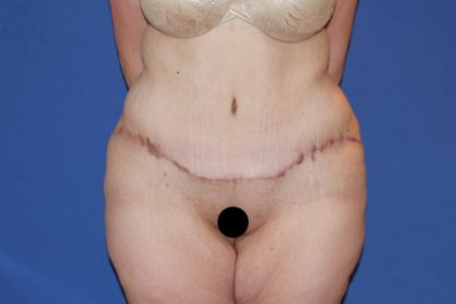 Tummy Tuck Before & After Patient #3246