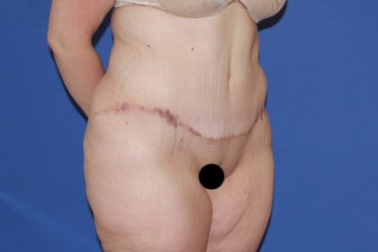 Tummy Tuck Before & After Patient #3246